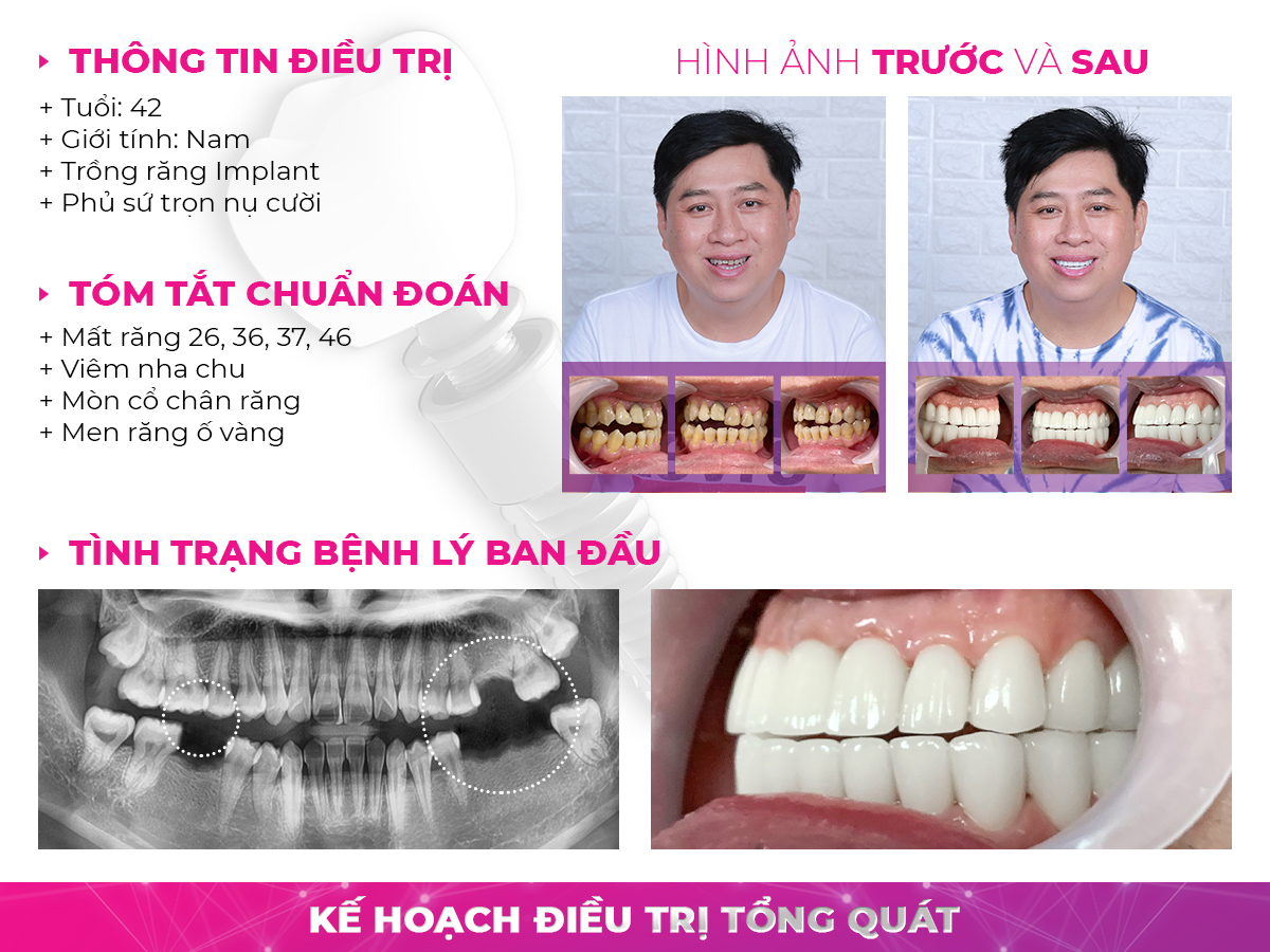 trồng răng implant hà nội