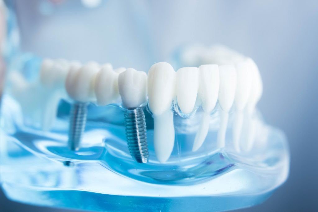 trồng răng implant có nguy hiểm không,làm răng implant có nguy hiểm không