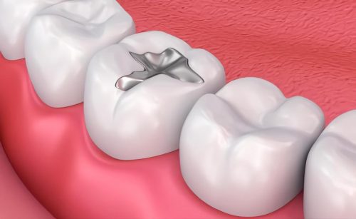 bị sâu răng nên làm gì, bi sau rang nen lam gi, khi bị sâu răng nên làm gì, khi bi sau rang nen lam gi
