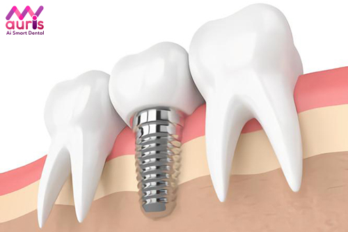 trồng răng implant, trong rang implant