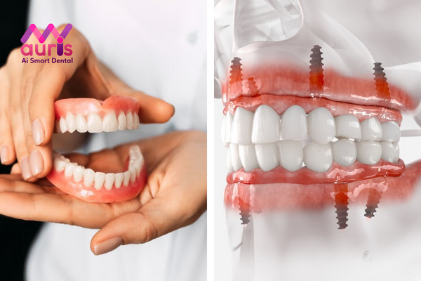 trồng răng giả cả hàm