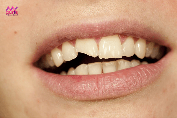 trồng răng bị gãy