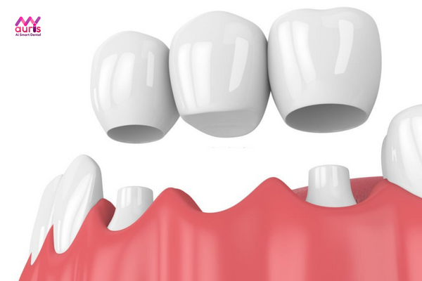 trồng răng cửa hàm trên