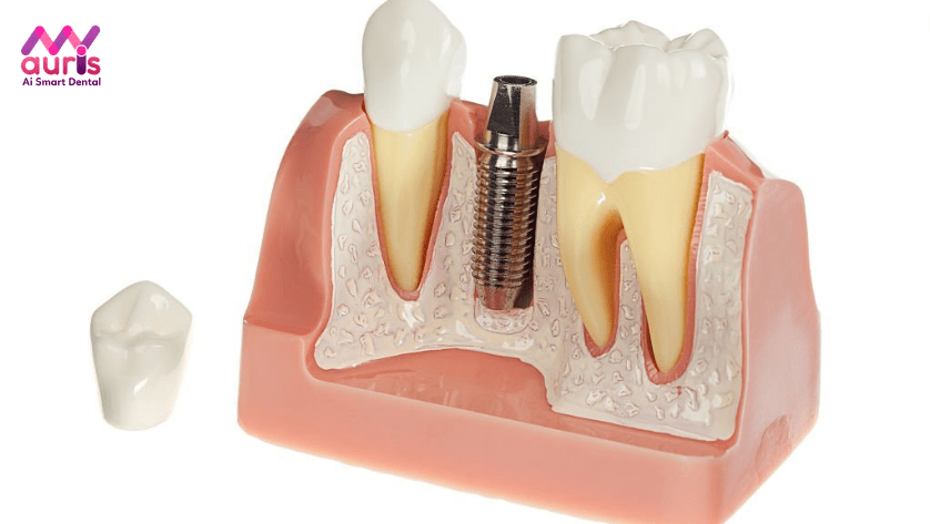 trồng răng implant có bị hôi miệng không