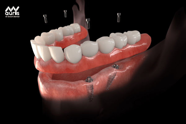 trồng răng giả nguyên hàm