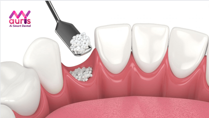 chăm sóc răng sau cấy implant