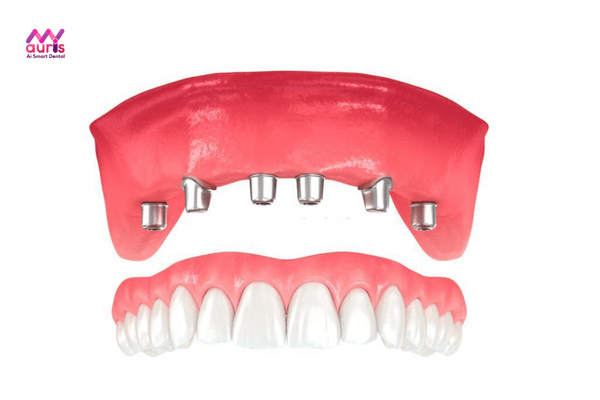 trồng răng cả hàm