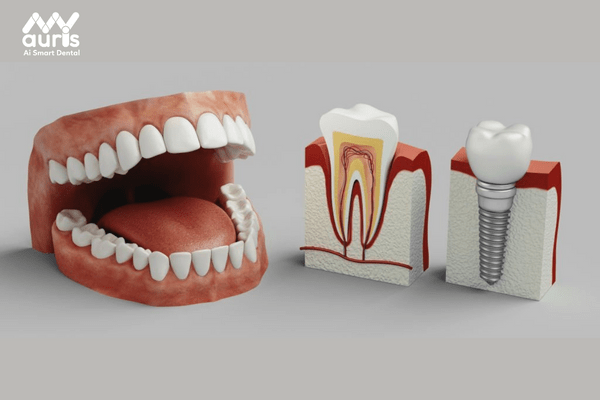 Trồng răng cấm bằng Implant