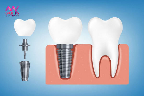 Trồng răng Implant là phương pháp gì?