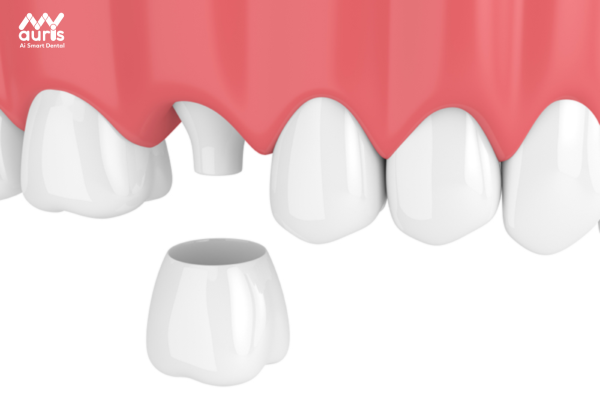 Bọc răng sứ - Trồng răng khểnh khi còn răng 