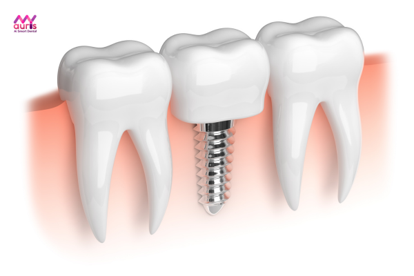 Trồng răng implant - Trồng răng khểnh khi mất răng 